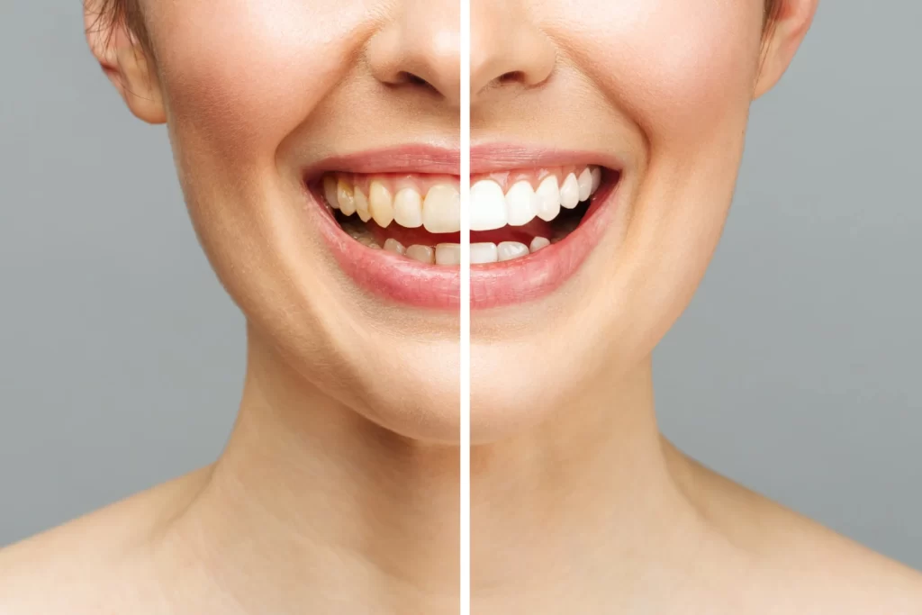 : Sur une même image, à gauche, une bouche avec des dents jaunes, illustrant l'état avant le blanchiment dentaire. À droite, la même bouche, mais cette fois avec des dents blanches et éclatantes, représentant le résultat après le blanchiment dentaire. Cette comparaison visuelle met en évidence l'efficacité du traitement de blanchiment.