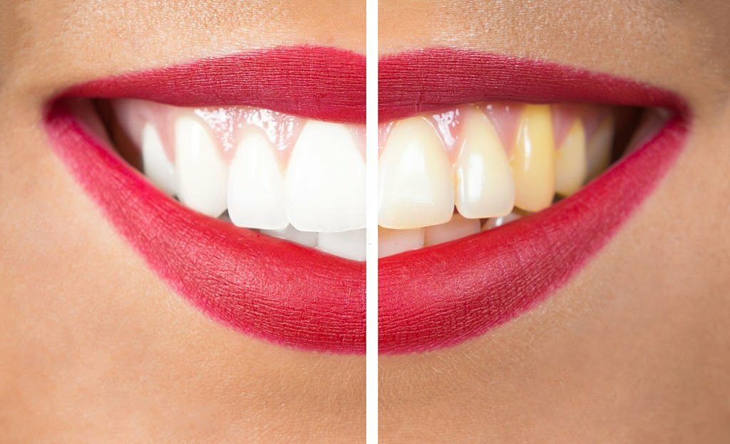 Image avant et après blanchiment dentaire, montrant un sourire avec du rouge à lèvres, la moitié avec des dents blanches et l'autre moitié avec des dents jaunes.